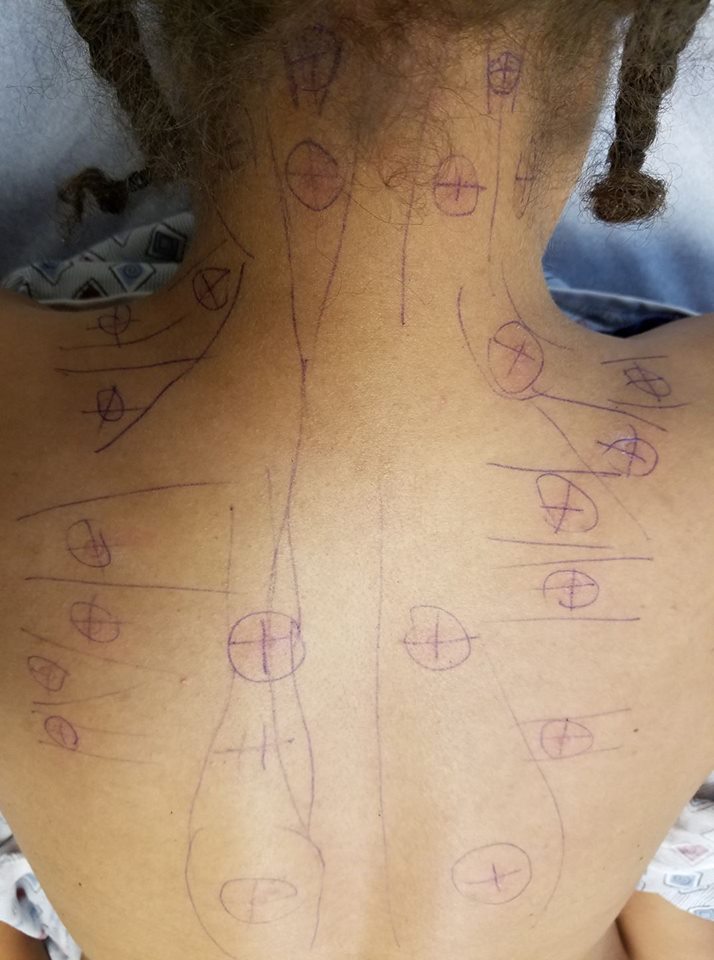 woman with a map of trigger points drawn on the back of her neck and shoulders