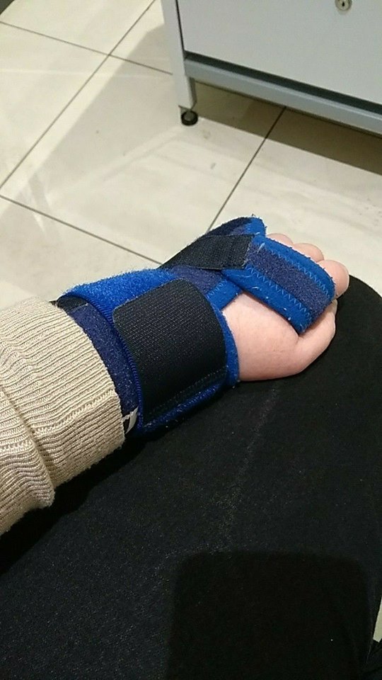 woman's swollen wrist with a brace around it