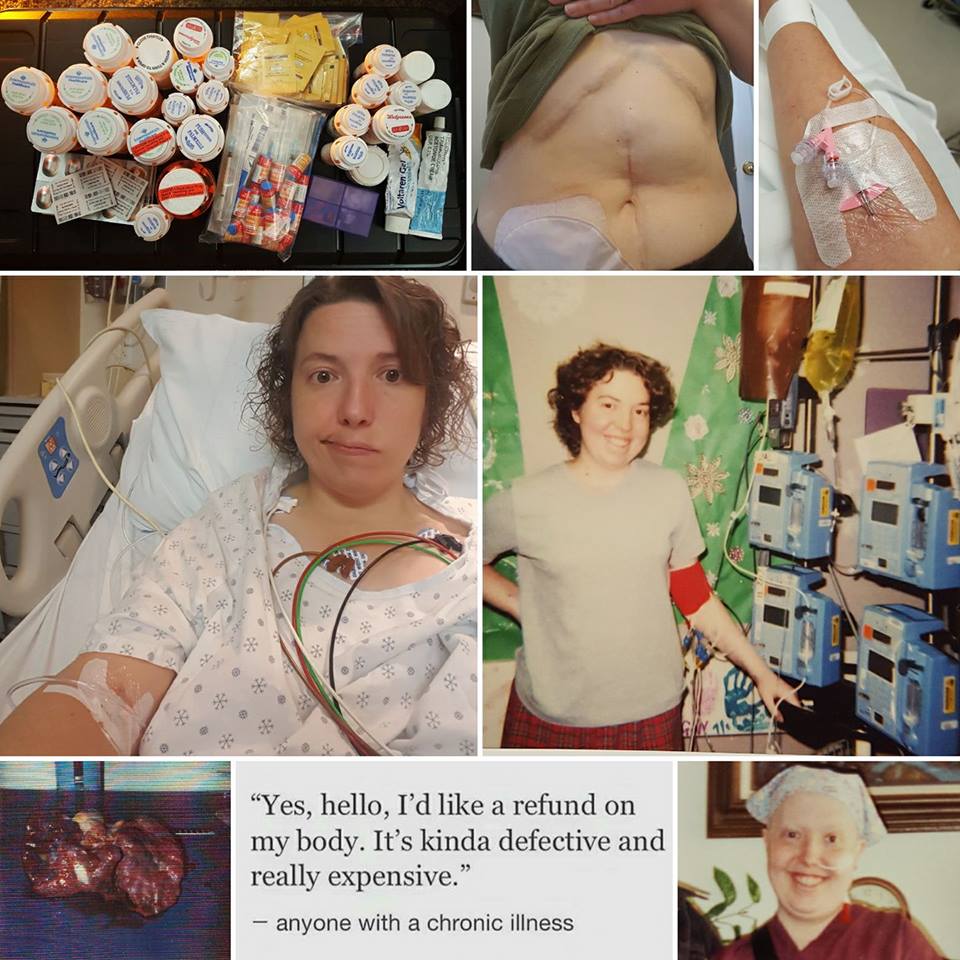 collage of photos of woman receiving treatment for autoimmune disease