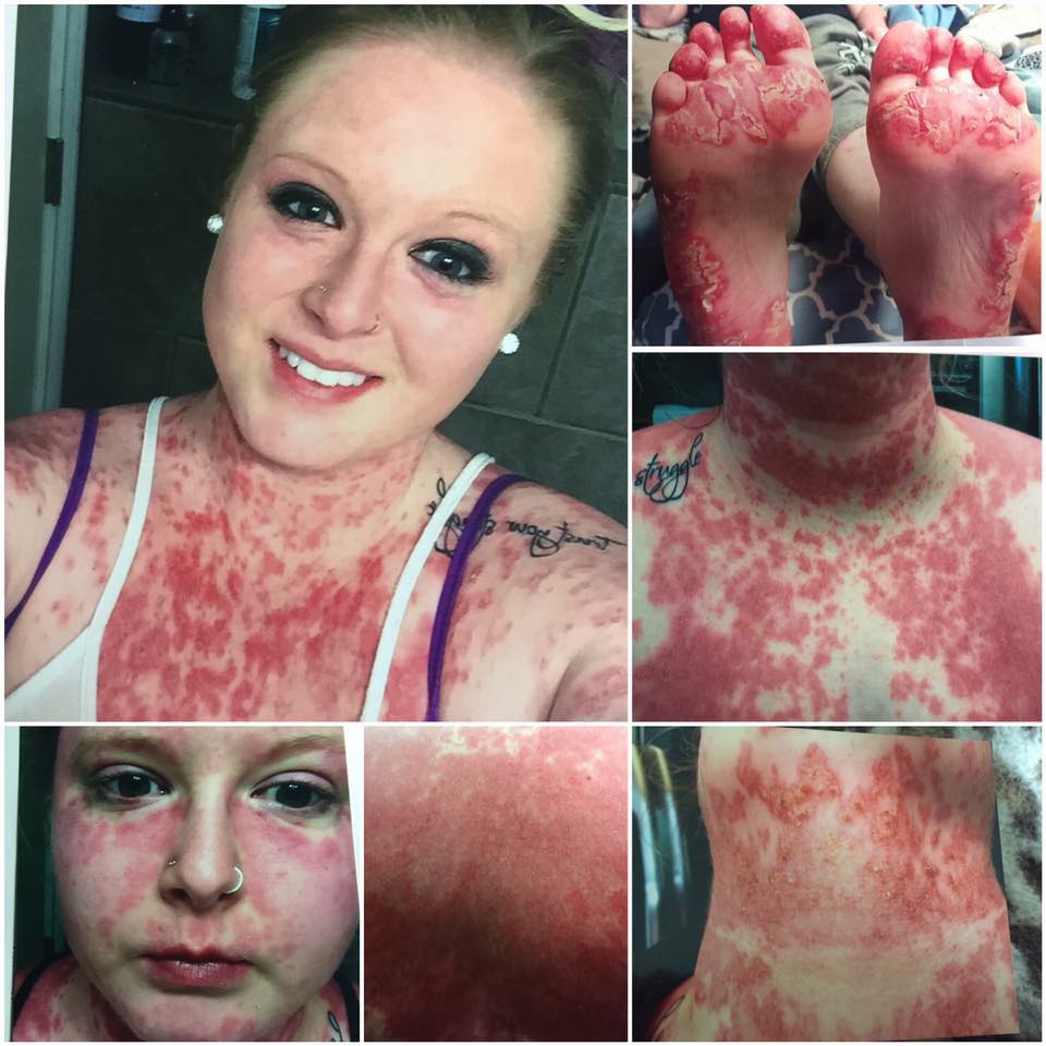 collage of photos of woman with red, flaky patches on her skin