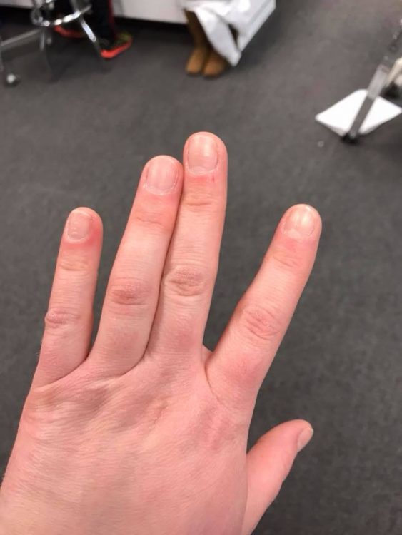 hand with two fingers stuck in position next to each other