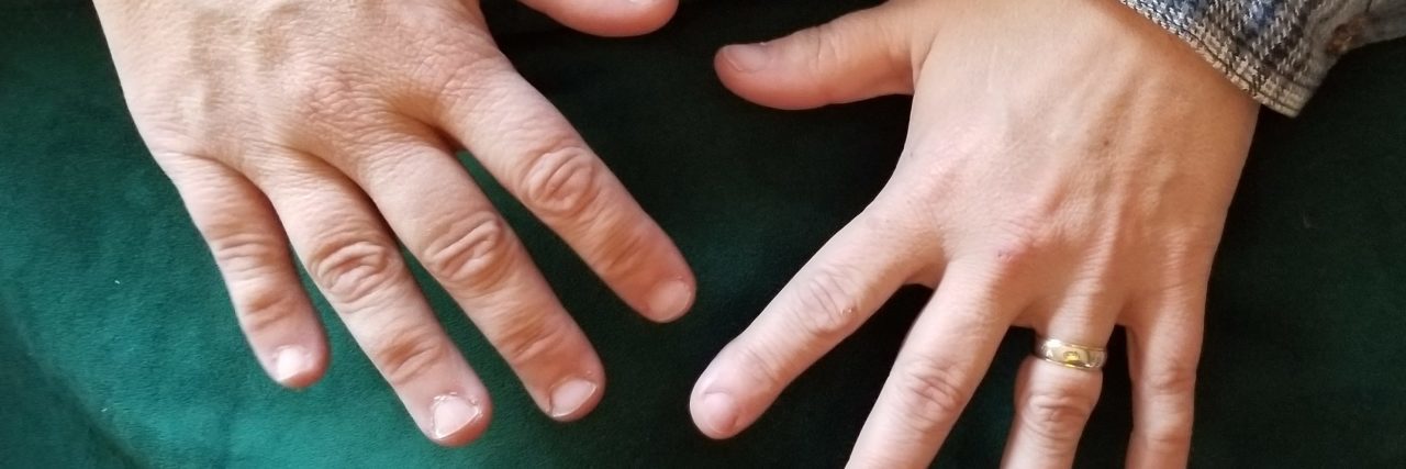 overhead view of hands with tardive dyskinesia