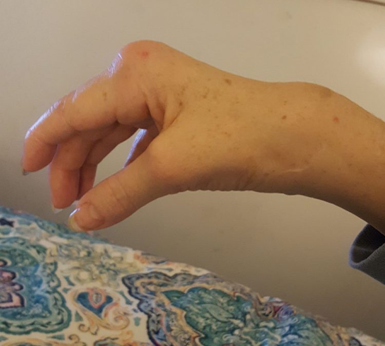 hand with large bump on knuckle