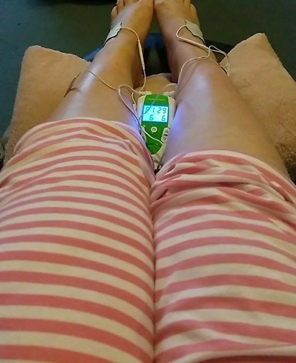 woman's legs with tens machine on ankles