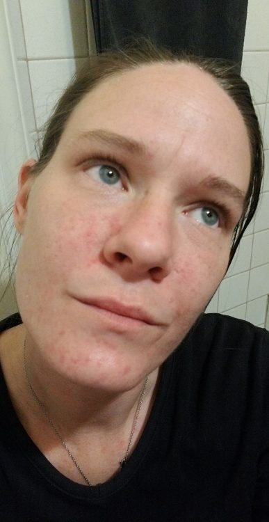 woman showing allergic reaction on face from mast cell activation disorder
