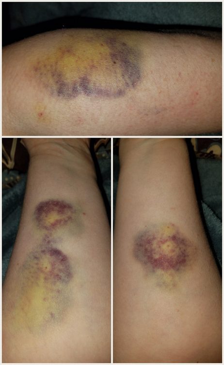 three photos of bruises on legs
