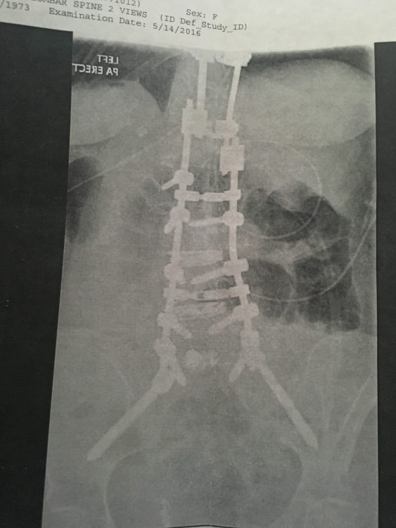 x ray of back and spine after surgery
