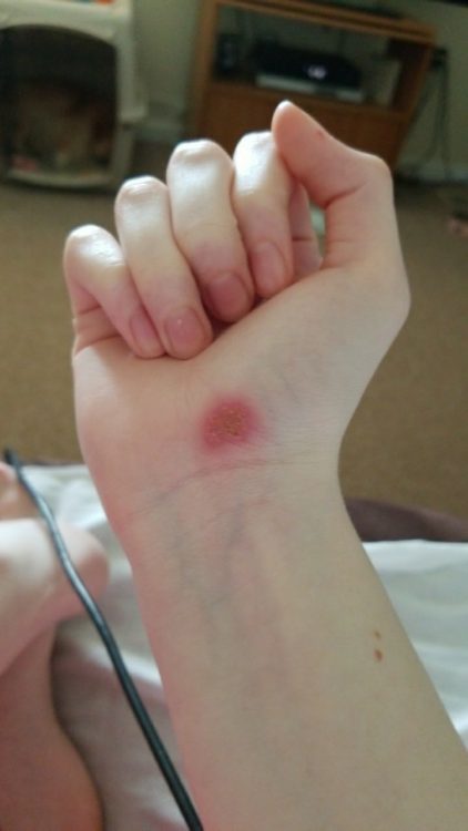hand with red burn spot above wrist
