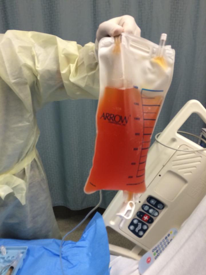 doctor holding a bag of fluid that was drained from a woman's lung