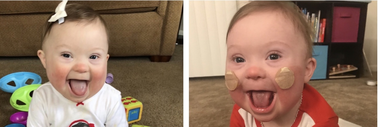 To My Daughter With Down Syndrome on Her 1st Birthday Photo collage. 1. Post open-heart surgery. 2. Smiling baby sitting on floor and tongue out. 3. Smiling baby with stickers for ng-tube on cheeks.