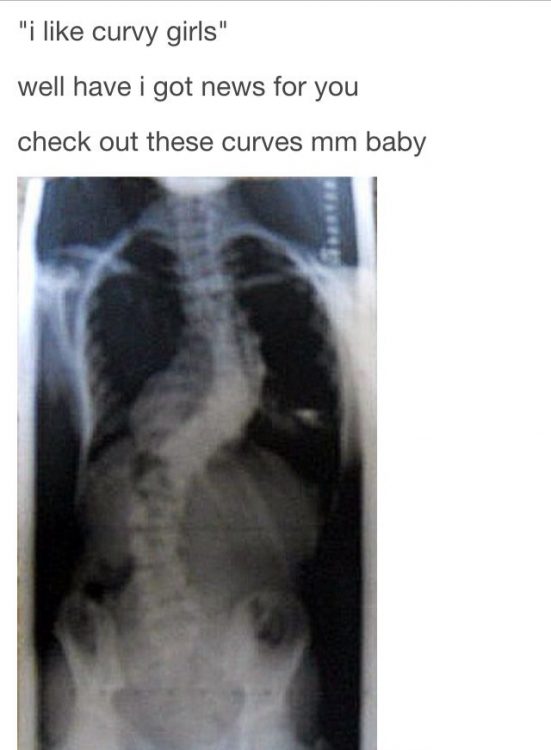 scoliosis x ray with text i like curvy girls, well have i got news for you. check out these curves mm baby
