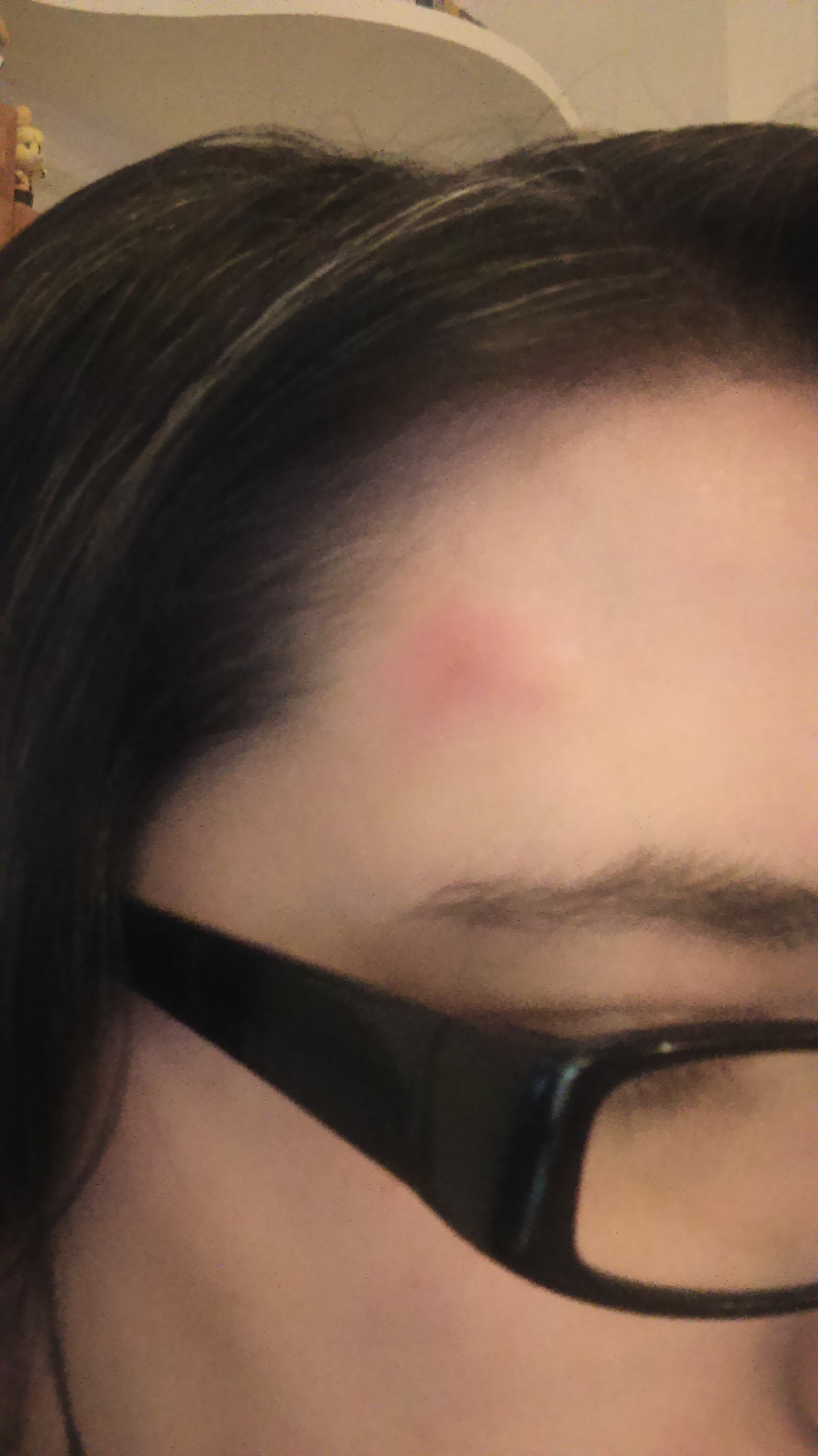 dermatillomania skin picking scar on forehead