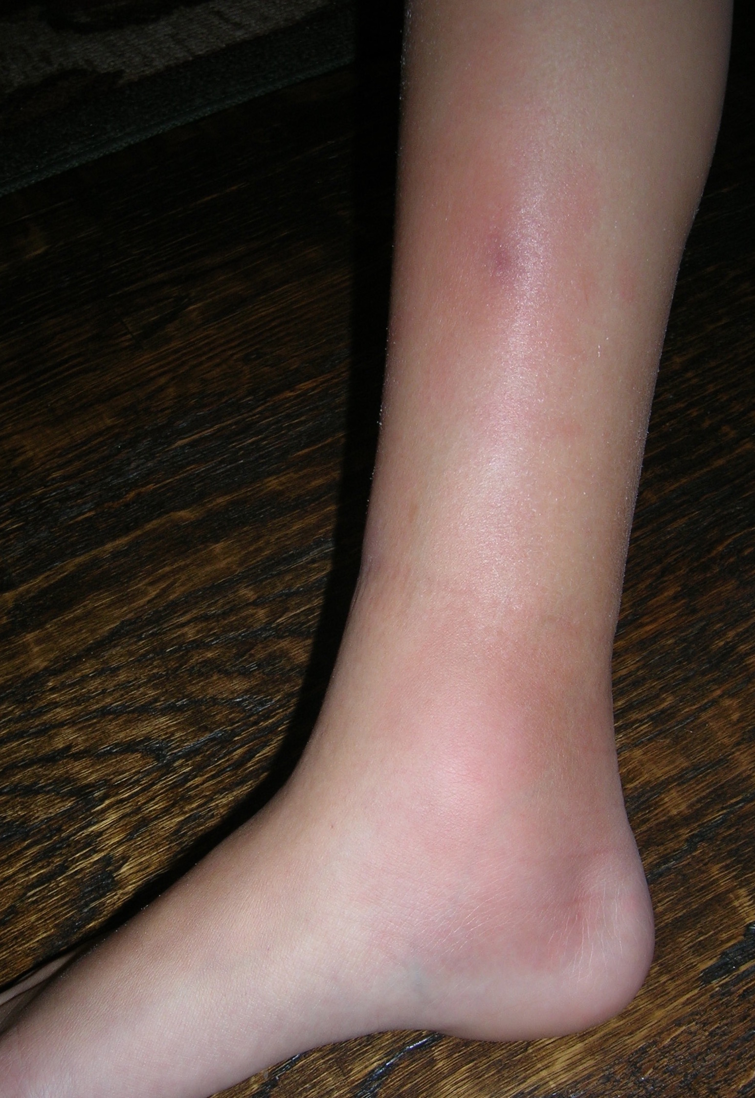 woman's leg with red lumps and swelling from erythema nodosum