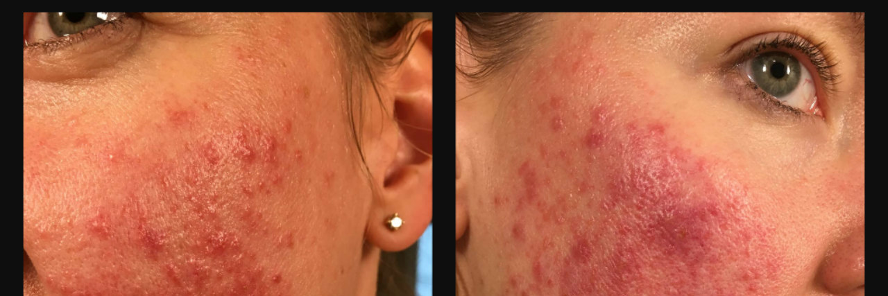 Rosacea: The Physical Condition I Didn't Realize My PTSD Could Cause rosacea pictures