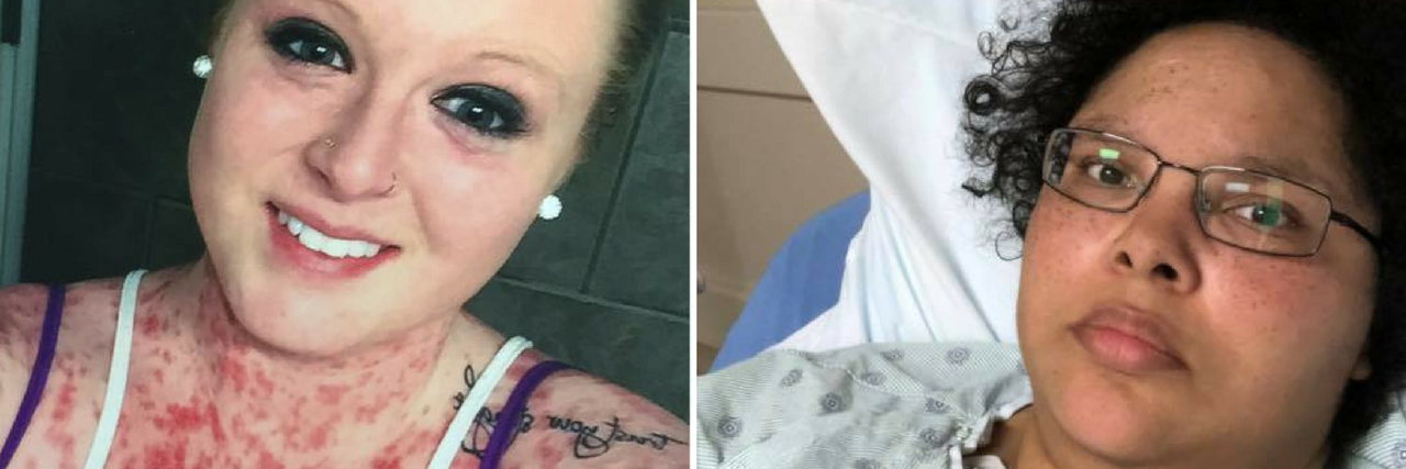 22 Photos That Show What Autoimmune Disease Really Looks Like woman with red, flaky patches on her skin and woman in the hospital