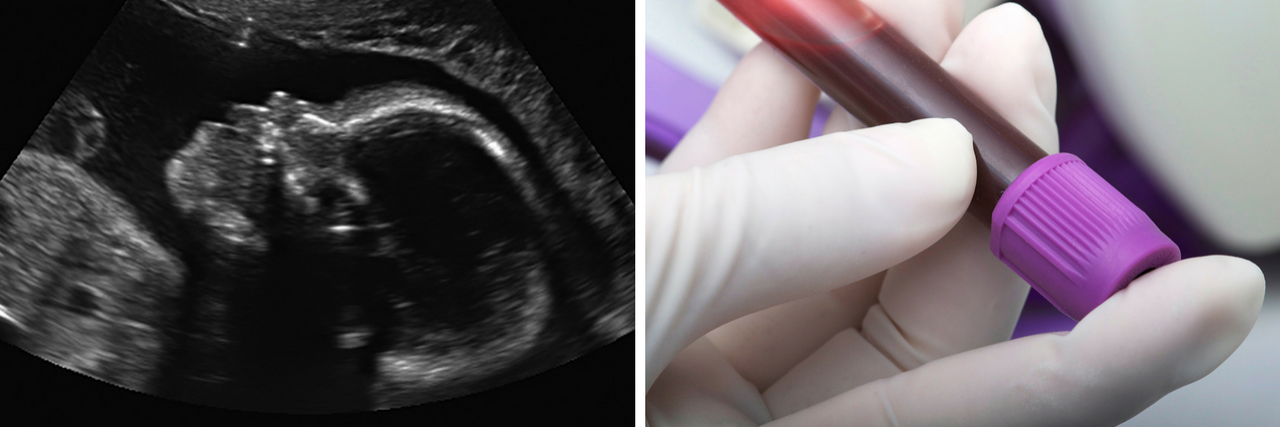 Ultrasound, Blood Test, and 'Peppa Pig' Research News for Autism Ultrasound and blood test