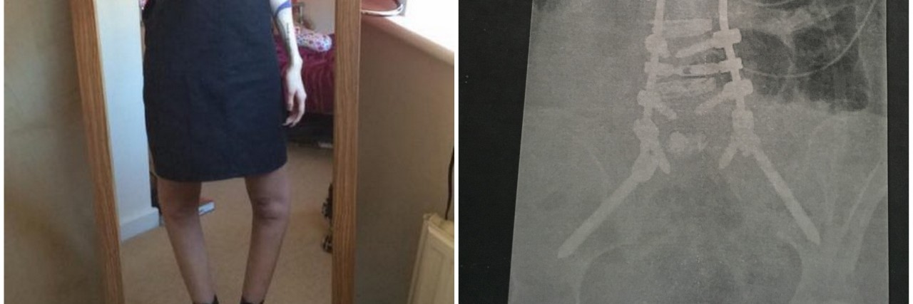 14 Photos That Show How Ehlers-Danlos Syndrome Can Manifest girl standing in front of mirror with knee hyperextended and photo of x ray after scoliosis surgery