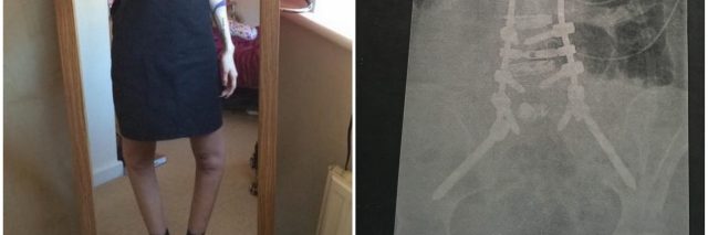 girl standing in front of mirror with knee hyperextended and photo of x ray after scoliosis surgery