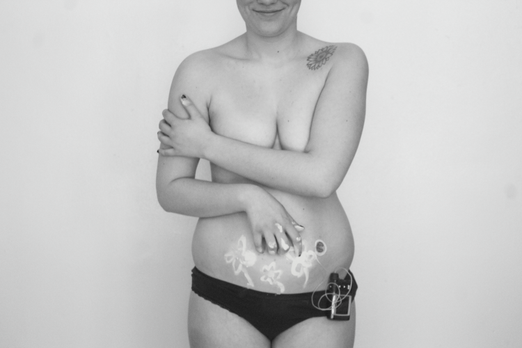 black and white photo of woman standing in just her underwear with a tube in her stomach visible