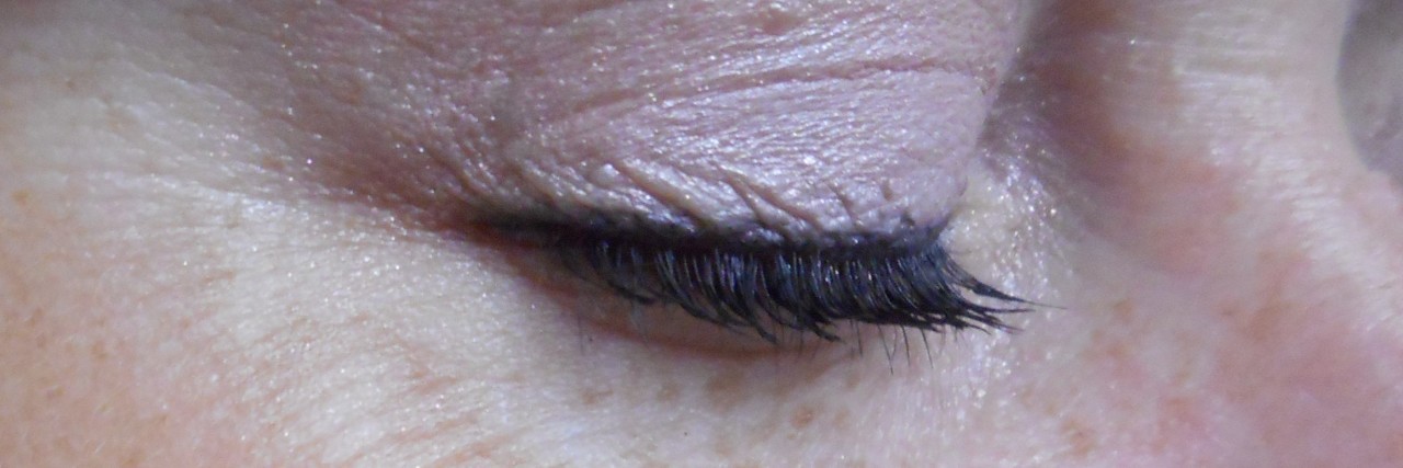 'I'd Rather Have Melanoma Than Be Pale!' The mole before the biopsy. Not quite a "sun spot!"