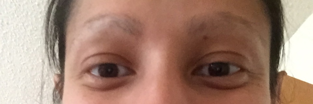 What Happened When My Eye Doctor Asked Me About My Missing Eyelashes