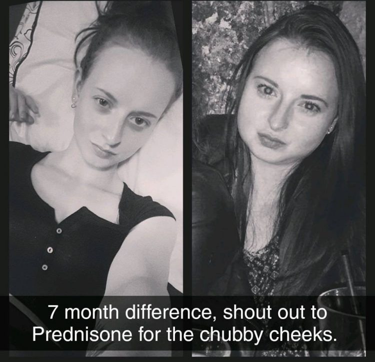 black and white before and after photos of a woman showing a 7 month difference in her face due to prednisone