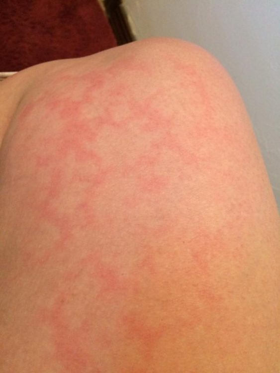 woman with a splotchy red heat rash on her inner right thigh and knee