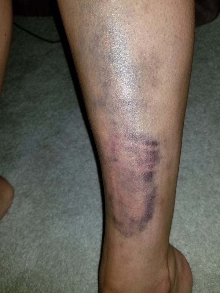 bruises on the back of a woman's leg