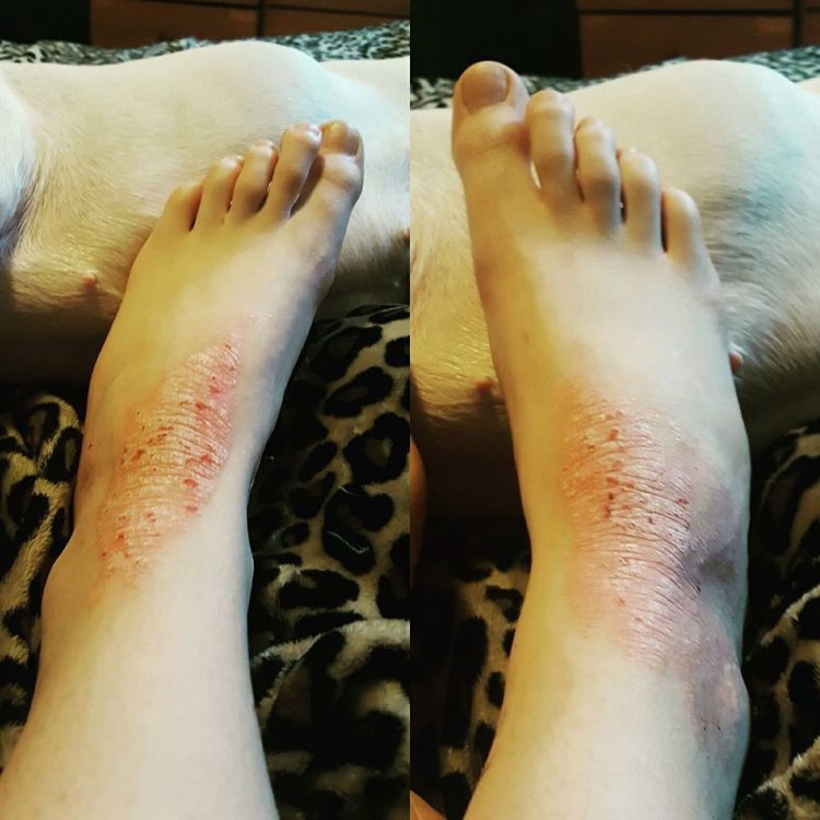woman's feet with psoriatic arthritis on the tops of her ankles