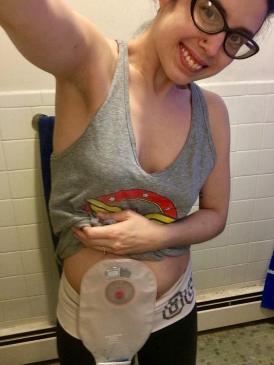 woman showing stoma bag