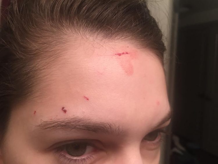 photo of a woman's eyes and forehead with several scratches and cuts that are bleeding