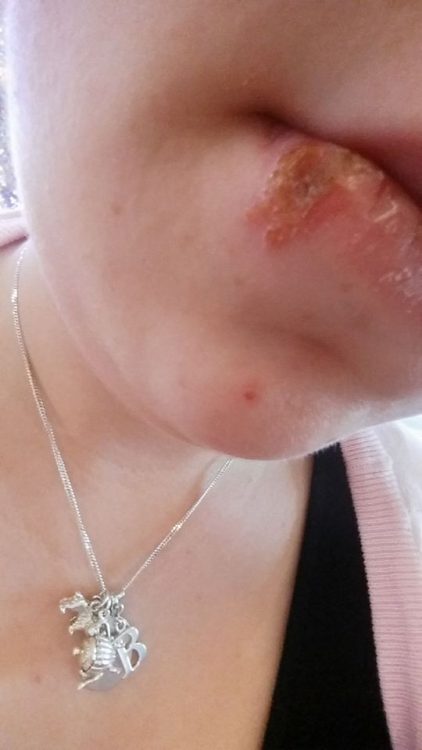 woman with a sore on her lip