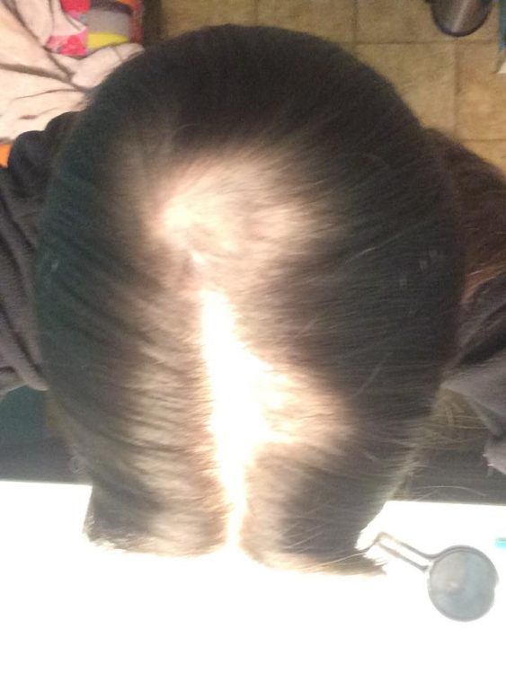 the back of a woman's head with several bald spots