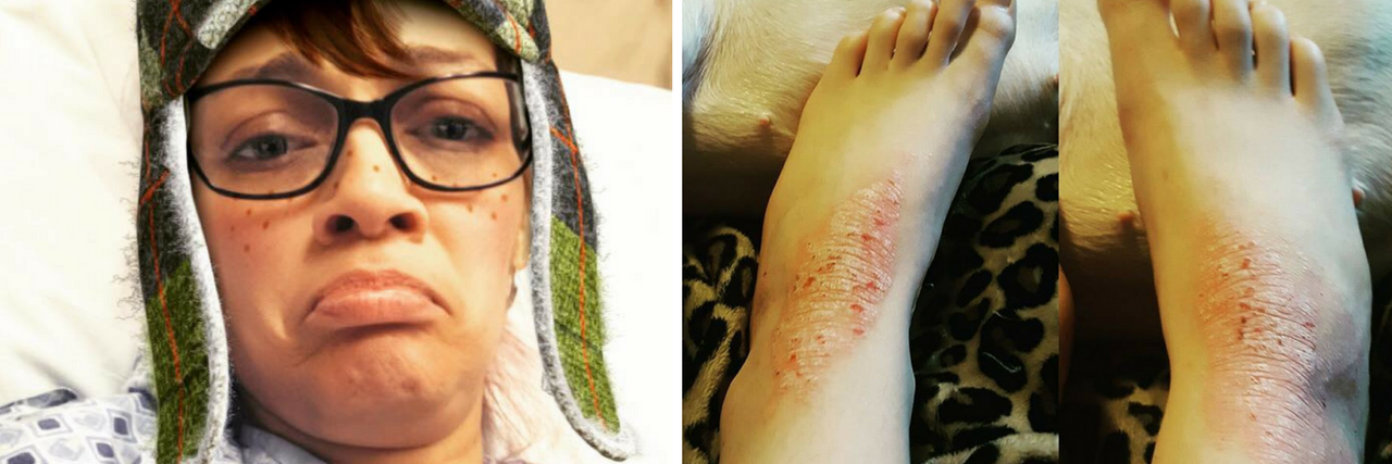 woman wearing glasses and a green hat while lying in a hospital bed and frowning, and a woman's feet with psoriatic arthritis on her ankles