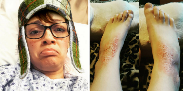 woman wearing glasses and a green hat while lying in a hospital bed and frowning, and a woman's feet with psoriatic arthritis on her ankles