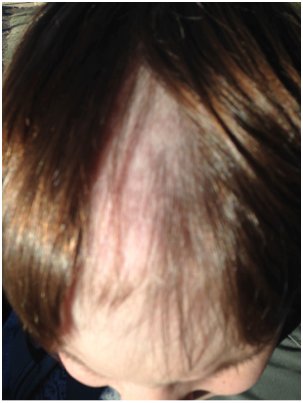 young boy trichotillomania bald patch on head