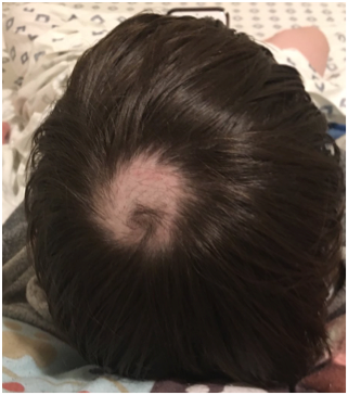 high school son trichotillomania bald patch