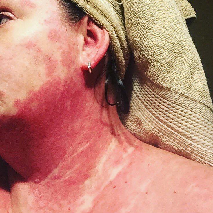 woman's neck, shoulders and chest with bright red rash