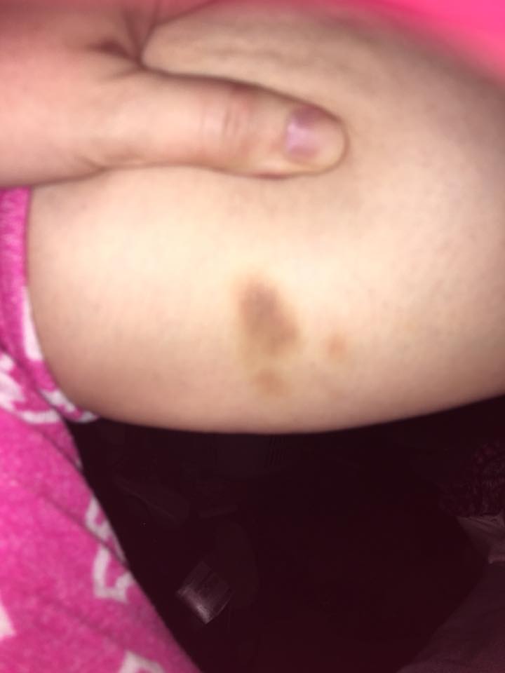 bruises on a woman's skin