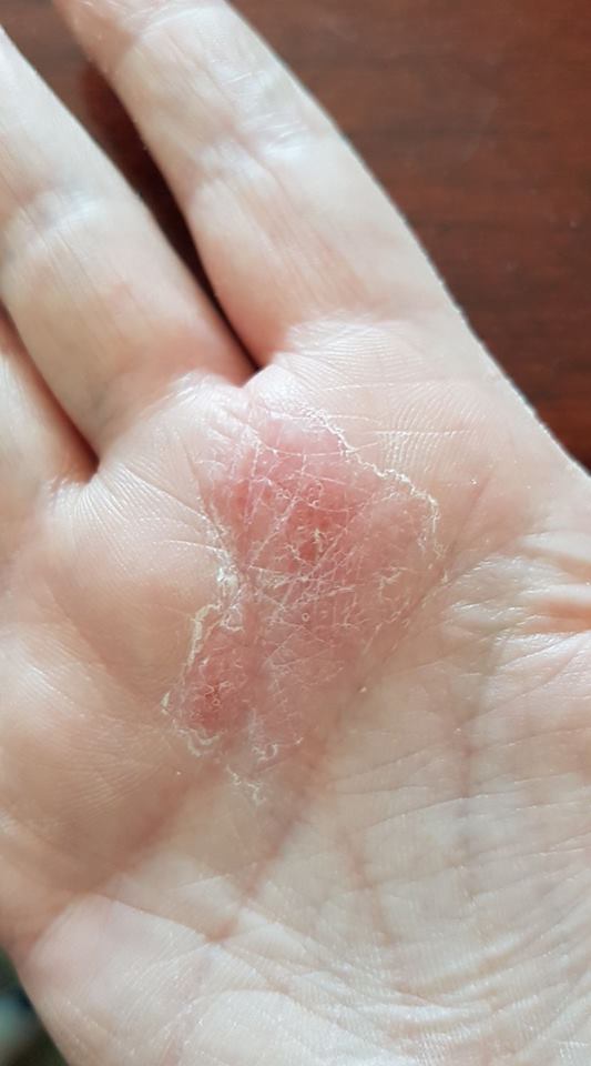 rash on the palm of a woman's hand