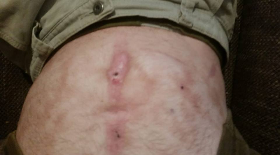 heating pad scarring on a man's stomach