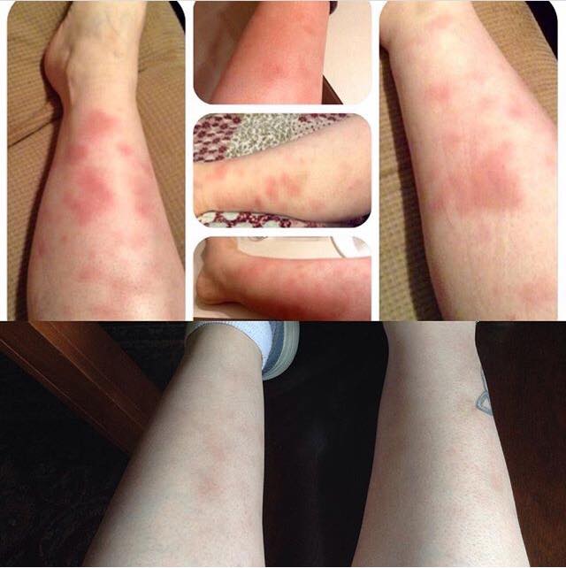 erythema nodosum on a woman's legs