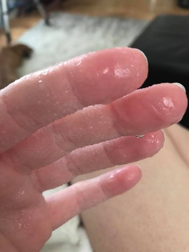 woman's hand covered in sweat