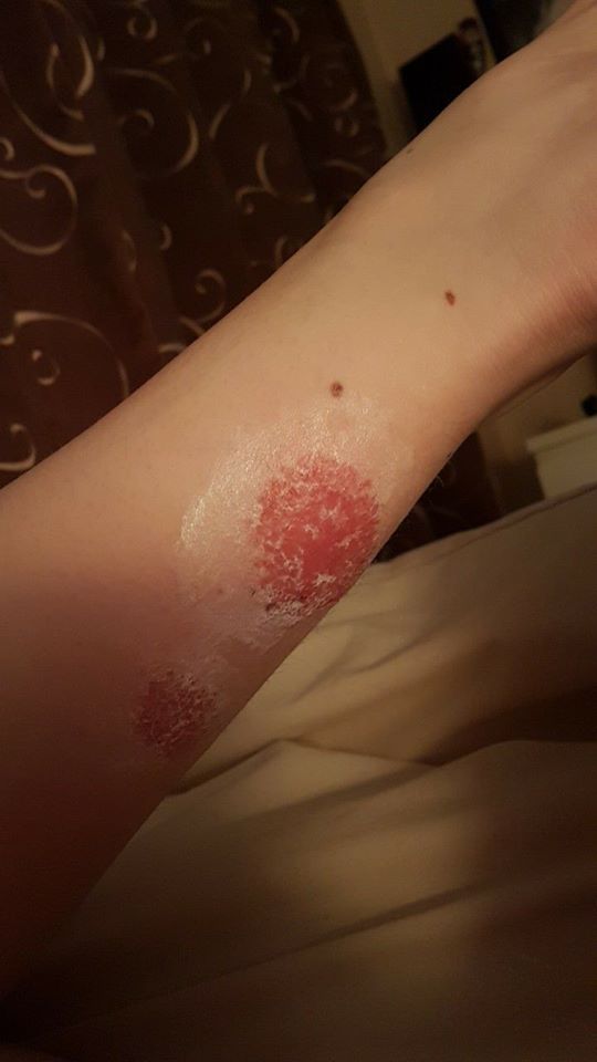 red patch on a woman's arm