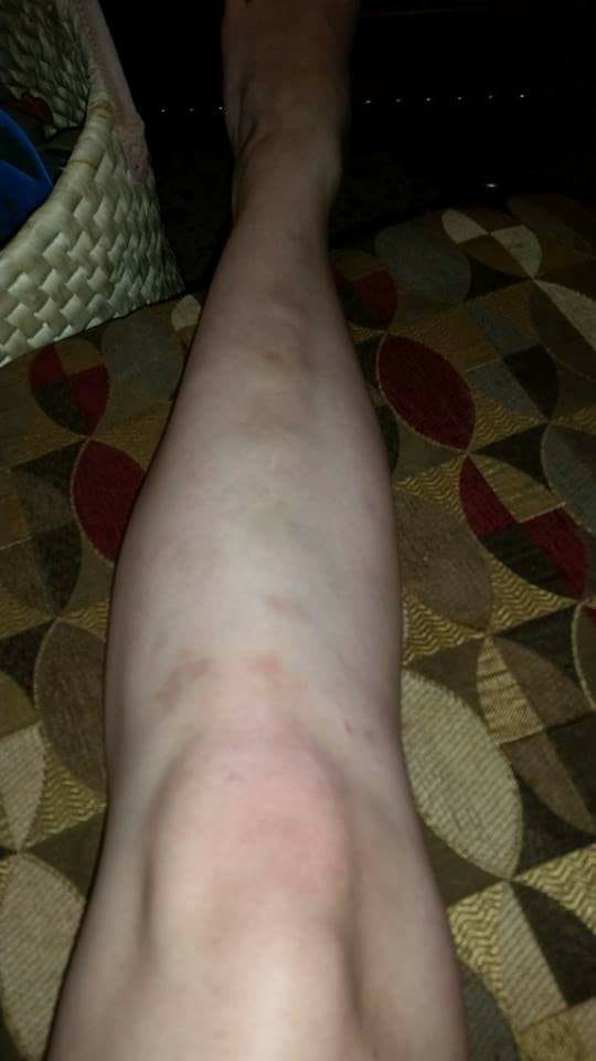 woman's leg with bumps and bruises all over from erythema nodosum