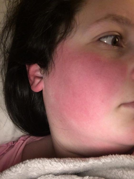 photo of a woman with flushed, red cheeks