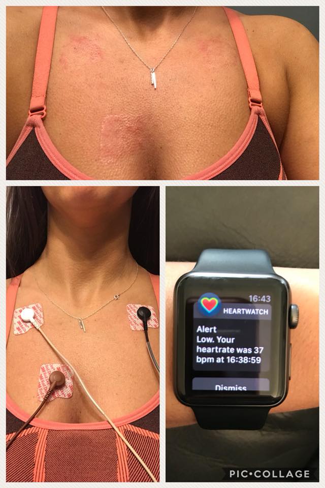 woman with rashes on her chest from where her heart monitor was