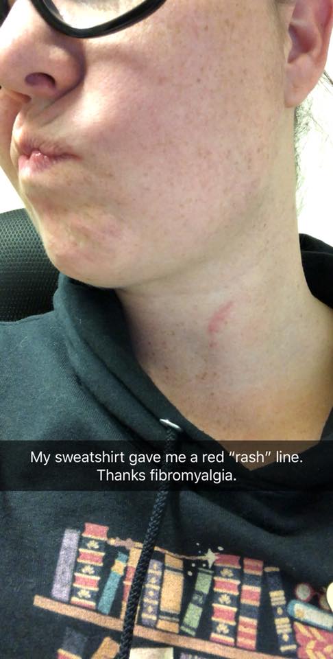 rashes on a woman's neck