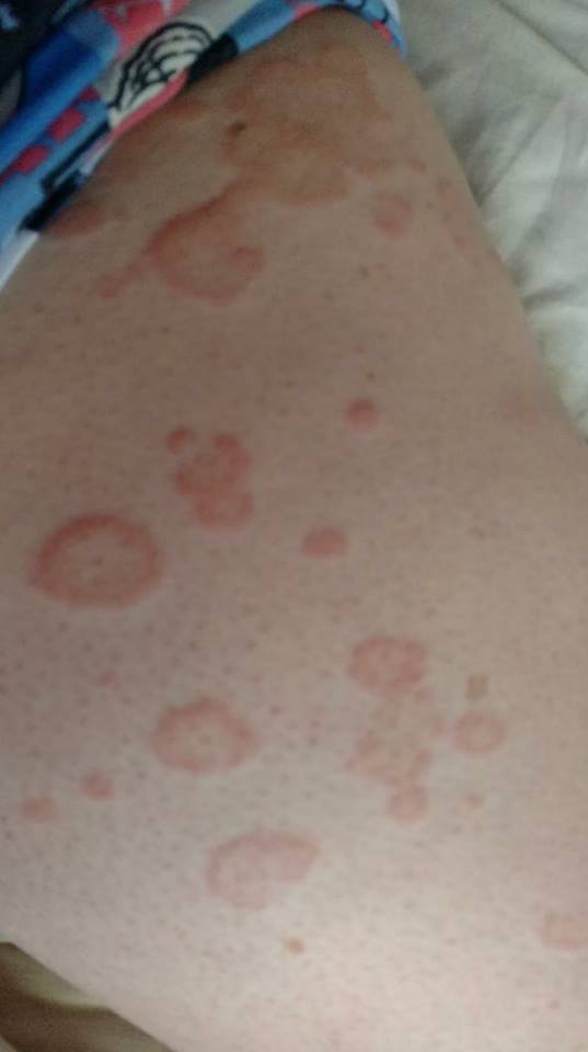 urticaria rash on a woman's upper thigh