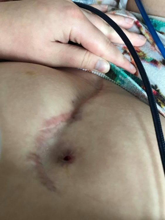 scar on woman's stomach